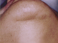 Chin Laser Hair Removal After