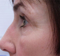 Scarring after microdermabrasion