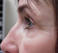 Scarring before microdermabrasion