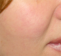 Face after microdermabrasion