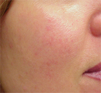 Face before microdermabrasion