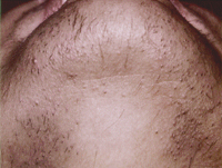 Chin Laser Hair Removal Before
