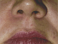 Lip Laser Hair Removal After