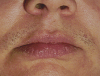 Lip Laser Hair Removal Before